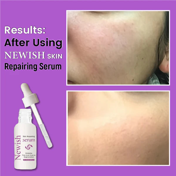Newish Skin Repairing Serum – For Acne Scars