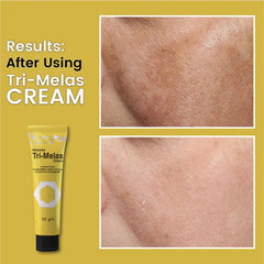 Tri Melas Cream - Best Melasma Cream