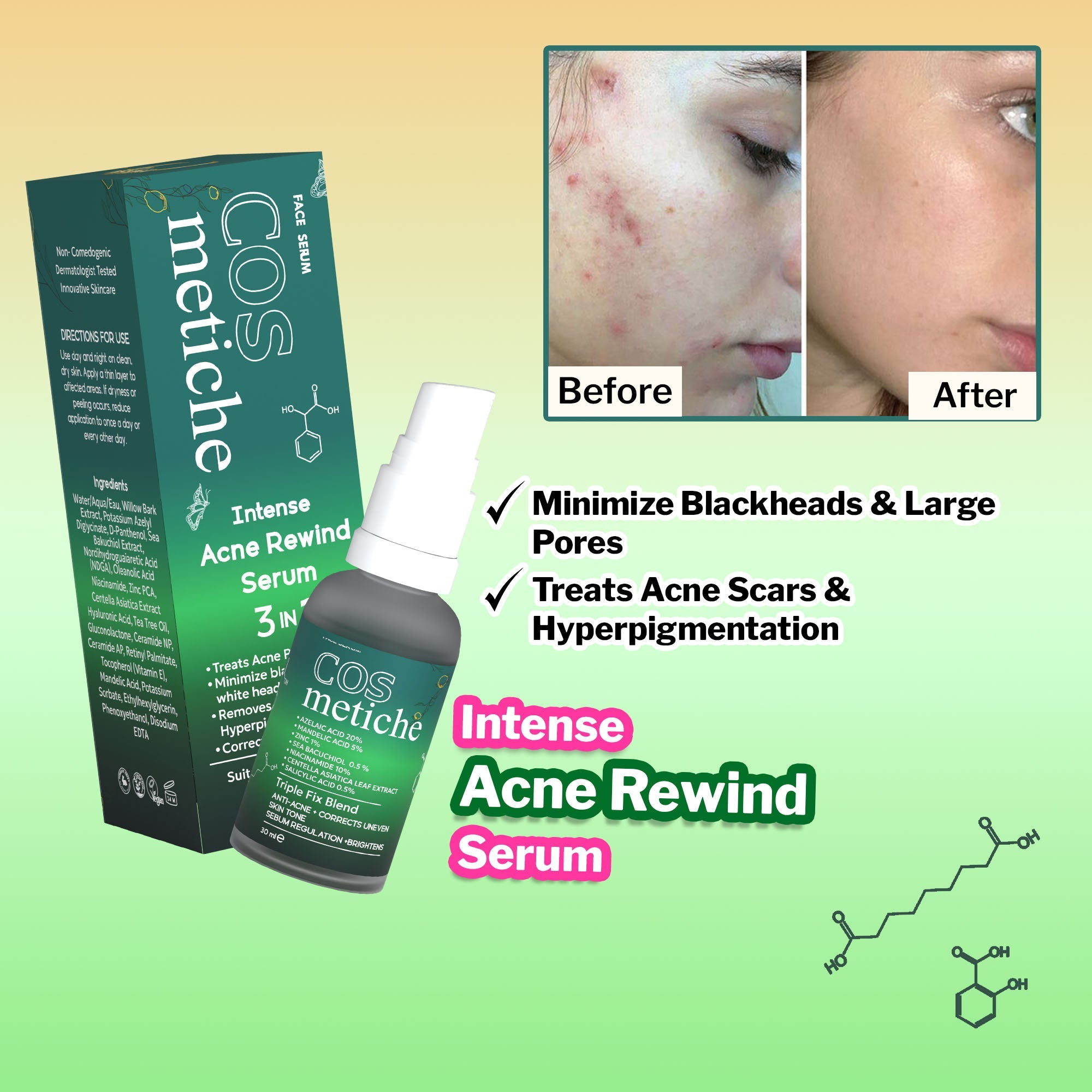 Intense Acne Rewind Serum