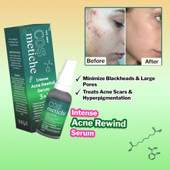 Intense Acne Rewind Serum